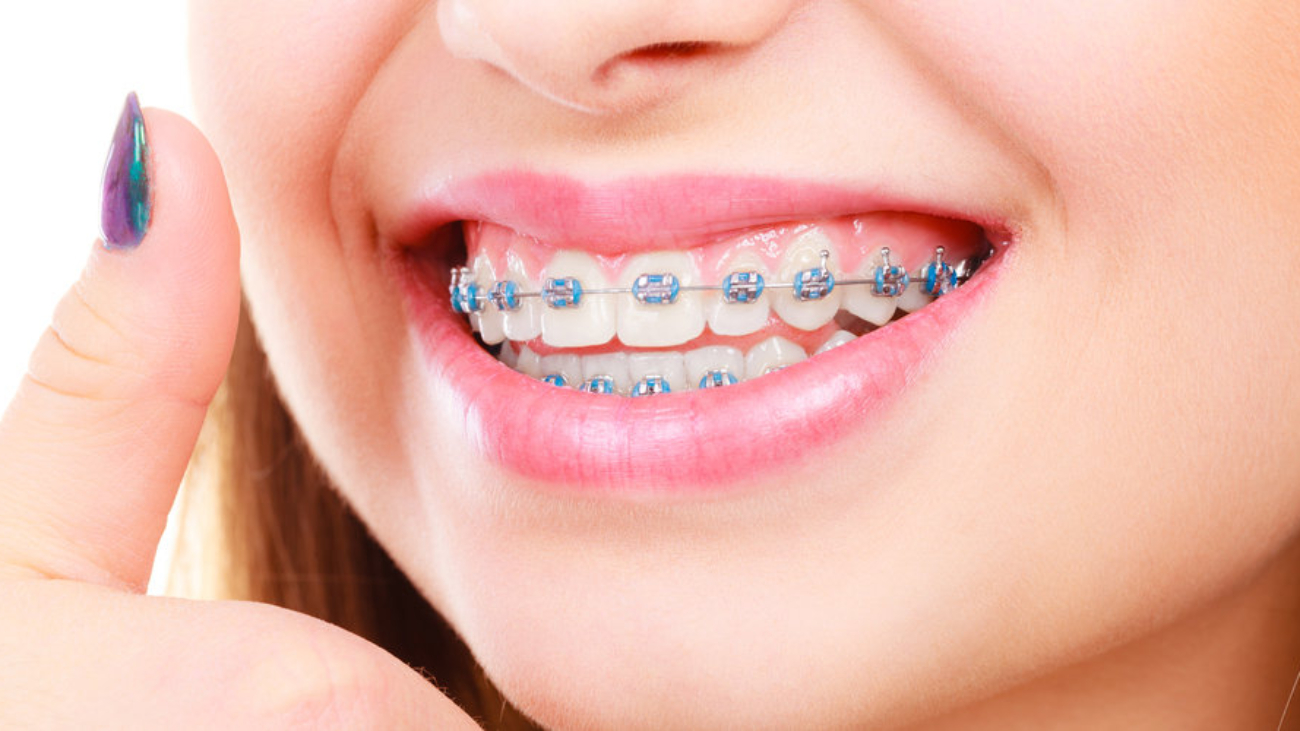 brackets