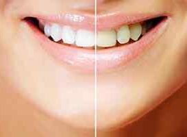 Blanqueamiento Dental - HC Odontologos - Clinica Dental Merida