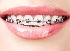 Brackets Metalicos - HC Odontologos - Clinica Dental Merida