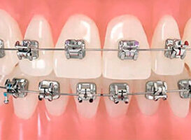 Brackets de Autoligado - HC Odontologos - Clinica Dental Merida