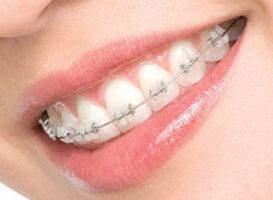 Brackets de porcelana - HC Odontologos