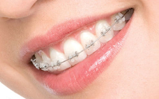 Brackets de porcelana - HC Odontologos