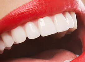 Carillas - HC Odontologos - Clinica Dental Merida