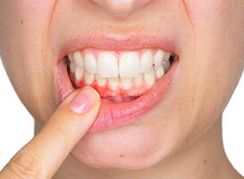 Enfermedad Periodontal - HC Odontologos- Clinica Dental Merida