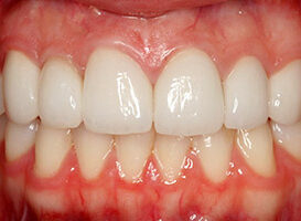 Estetica Periodontal - HC Odontologos - Clinica Dental Merida