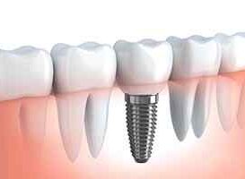 Implantes Dentales - HC Odontologos - Clinica Dental en Merida