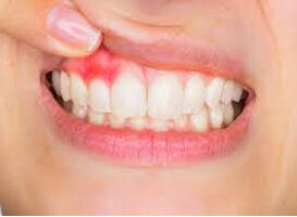 gingivitis - HC Odontologos - Clinica dental en merida